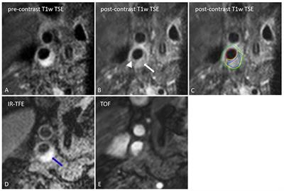 Emerging Role of Carotid MRI for Personalized Ischemic Stroke Risk Prediction in Patients With Carotid Artery Stenosis